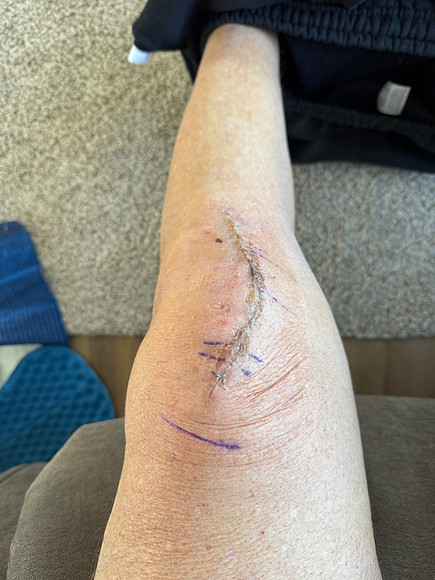 1-9-26 Jim Knee Partial Replacement (3)
