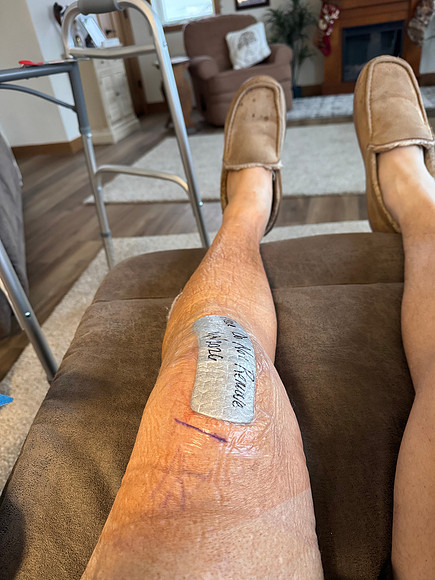 1-9-26 Jim Knee Partial Replacement (1)
