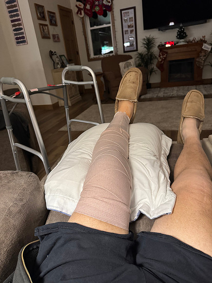 1-9-26 Jim Knee Partial Replacement (2)